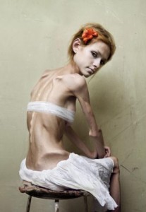 anorexia2
