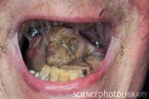 Tongue cancer