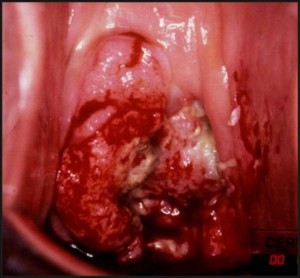 Cervical Cancer