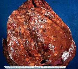Liver_cancer_nodular_hodgkins_metast_liver_cancer