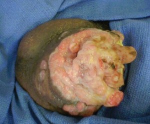 Penile_Cancer