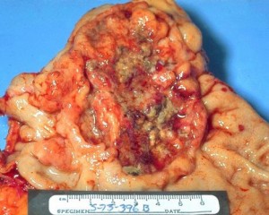 Stage_Iv_Gastric_Cancer-3