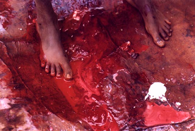 Somalia Genital Mutilation