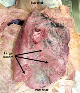 large-cell-lung-cancer