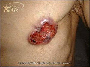 male_breast_cancer-21109