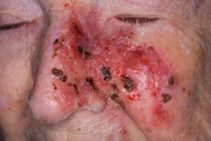skin_cancer-1479