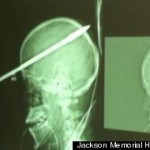 s-YASSER-LOPEZ-SPEAR-BRAIN-INJURY-MIAMI-large