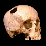 Crane-trepanation