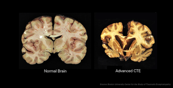 CTE brain